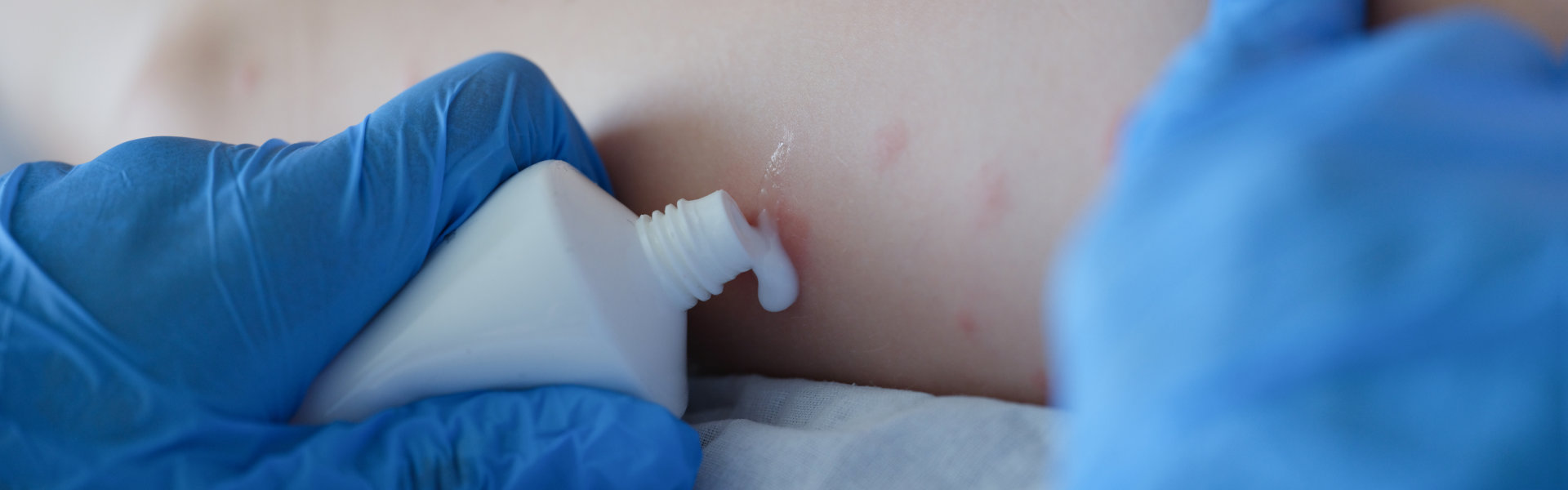 treating skin with insect bite cream